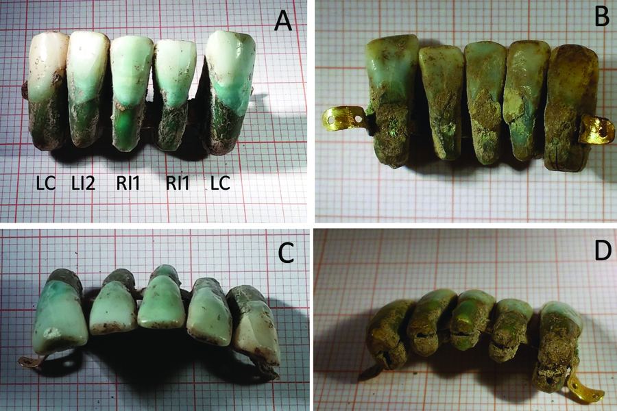 Image of the Oldest Known Denture