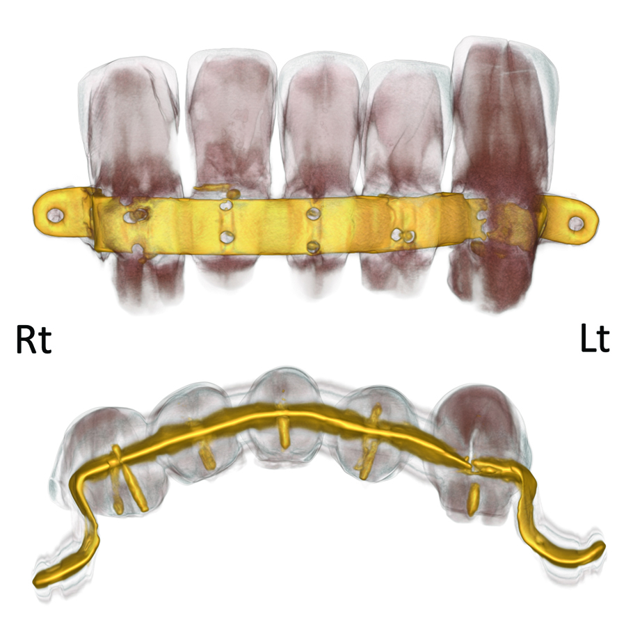 X-Ray of the Oldest Known Denture